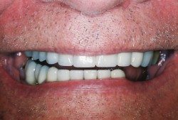 Porcelain Crowns and Dental Bridges Patient After