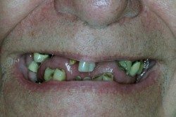 Porcelain Crowns and Dental Bridges Patient Before