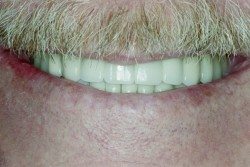 Porcelain Crowns and Dental Bridges Patient Before