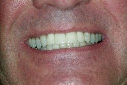 Porcelain Crowns and Dental Bridges Patient After