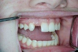 Dental Implants Patient Before Image
