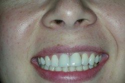 Dental Implants Patient After Image