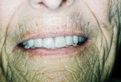 Teeth In A Day Patient After Image