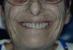 Teeth In A Day Patient Before Image