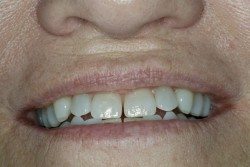 Dental Veneers Patient Before Image