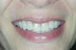 Dental Veneers Patient After Image