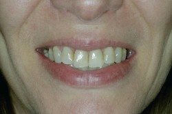 Dental Veneers Patient Before Image