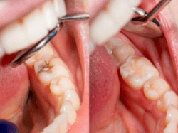 Before and after image of a cavity and a dental filling general dentistry dentist in Lilburn Georgia